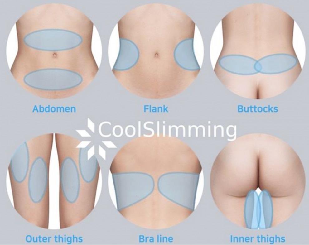 Cryolipolysis Treatment Areas